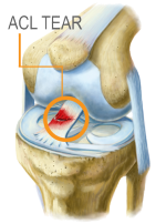 ACL Torn
